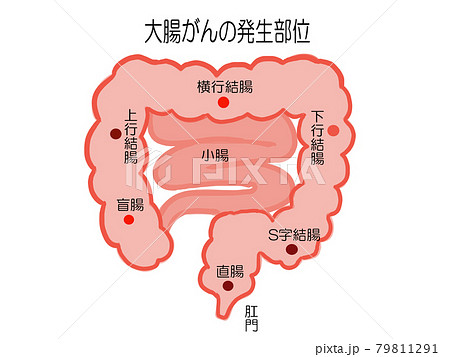 大腸がん 発生部位のイラスト 大腸がん 発生部位のイラスト 79811291