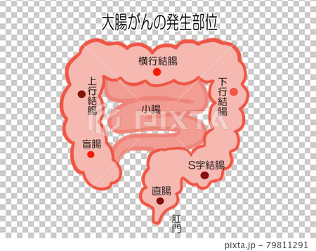 大腸がん 発生部位のイラスト 大腸がん 発生部位のイラスト 79811291