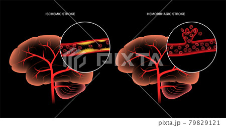 Brain stroke ishemic and hemorrhagic 79829121