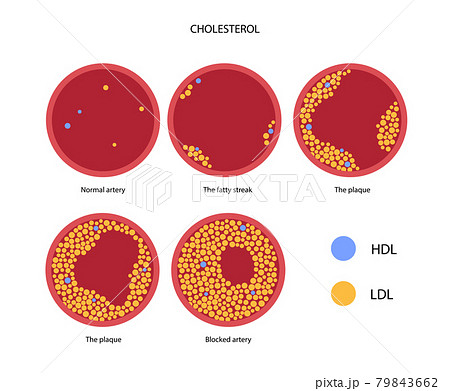 Cholesterol blood artery 79843662