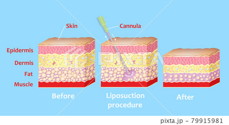 Mechanism of liposuction. Suction-assisted liposuction. Mechanism of liposuction. Suction-assisted liposuction. 79915981