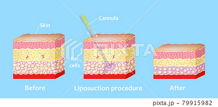 Mechanism of liposuction. Suction-assisted liposuction. 79915982