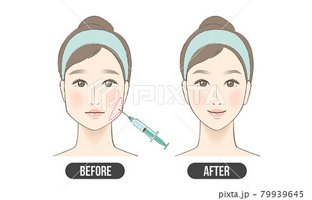 エラ ボトックス(カラー) エラ ボトックス(カラー) 79939645