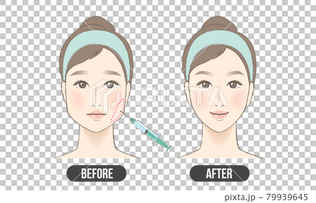 エラ ボトックス(カラー) エラ ボトックス(カラー) 79939645