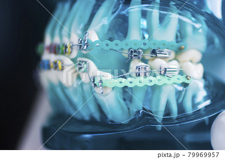 Dental teeth aligners brackets Dental teeth aligners brackets 79969957