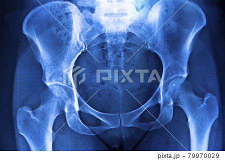Hips pelvis xray scan 79970029