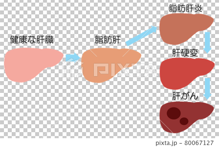 肝臓病 脂肪肝から肝硬変、肝がんに進行するイラスト 肝臓病 脂肪肝から肝硬変、肝がんに進行するイラスト 80067127
