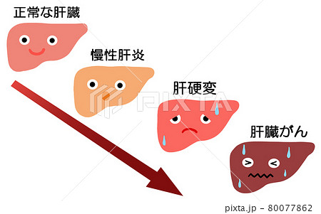 肝臓病 4つの進行を見るイラストのイラスト素材