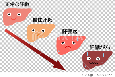 肝臓病　4つの進行を見るイラスト 80077862