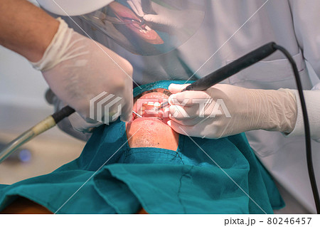 dentist cleaning the teeth patient with ultrasonic tool 80246457
