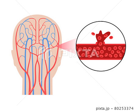 Brain stroke hemorrhagic 80253374