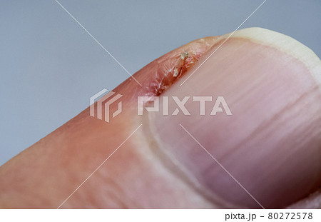 Inflamed cuticle on the finger. Damaged part of the finger, close-up. Inflamed cuticle on the finger. Damaged part of the finger, close-up. 80272578