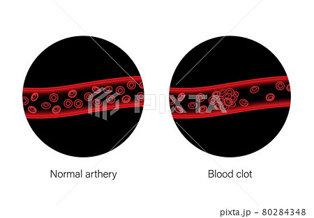 Brain stroke ishemic and hemorrhagic 80284348
