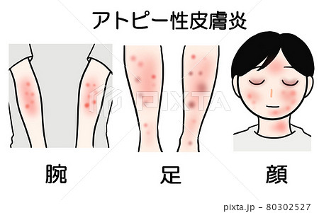 アトピー性皮膚炎 顔 足 腕 3つの症状のイラストのイラスト素材