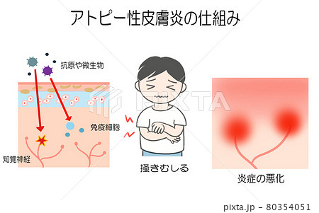 アトピー性皮膚炎 原因 悪化 仕組みのイラストのイラスト素材