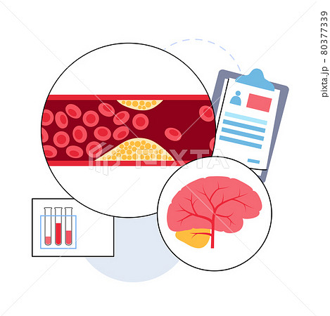 Brain stroke ishemic 80377339