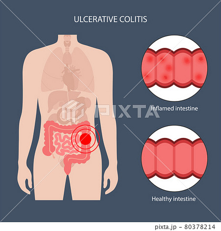 intestine ulcerative colitis 80378214