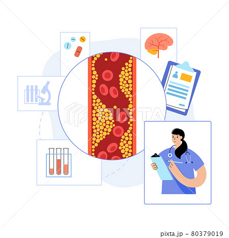 Brain stroke ishemic 80379019