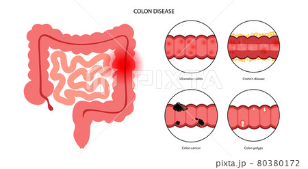 Intestines diseases concept 80380172