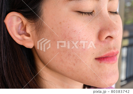 Side view close-up of woman face has variety problems on her skin (such as Acne, Pimple, Pores and Melasma etc). Conceptual of natural problem on woman skin. Side view close-up of woman face has variety problems on her skin (such as Acne, Pimple, Pores and Melasma etc). Conceptual of natural problem on woman skin. 80383742