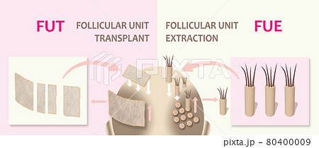 Methods of hair transplantation fut vs fue with infographic elements of illustration. Methods of hair transplantation fut vs fue with infographic elements of illustration. 80400009