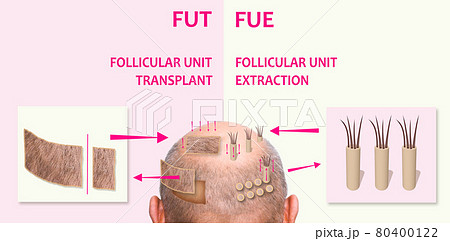 Methods of hair transplantation fut vs fue with infographic elements of illustration. Methods of hair transplantation fut vs fue with infographic elements of illustration. 80400122