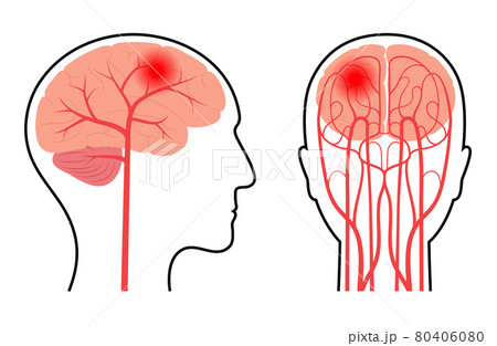 Brain pain disease Brain pain disease 80406080