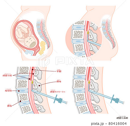 無痛分娩・硬膜外麻酔 80416004