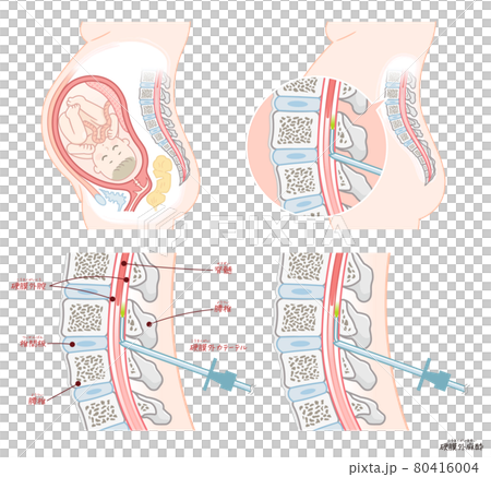 Painless delivery / epidural anesthesia 80416004