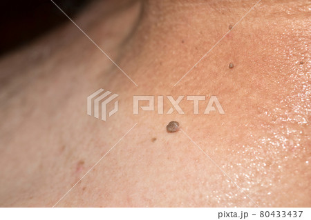 Papilloma located on a man's neck. 80433437