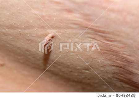 The papilloma is located on the man's abdomen next to the surgical suture. The papilloma is located on the man's abdomen next to the surgical suture. 80433439