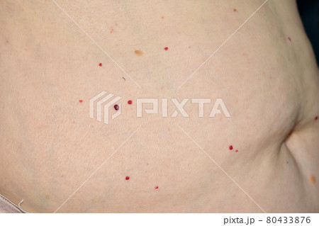 A lot of papillomas on the abdomen of a woman. A lot of papillomas on the abdomen of a woman. 80433876