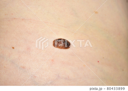 Close-up of a large mole on a woman's side. Close-up of a large mole on a woman's side. 80433899