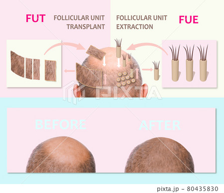 Methods of hair transplantation fut vs fue with infographic elements of illustration. Methods of hair transplantation fut vs fue with infographic elements of illustration. 80435830