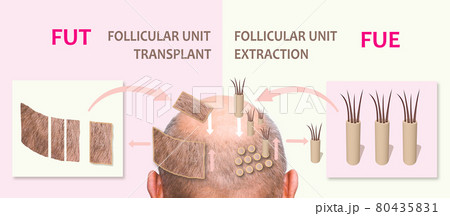 Methods of hair transplantation fut vs fue with infographic elements of illustration. 80435831