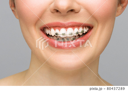 Orthodontic Treatment. Dental Care Concept. Beautiful Woman Healthy Smile close up. Closeup Ceramic and Metal Brackets on Teeth. Beautiful Female Smile with Braces. 80437289