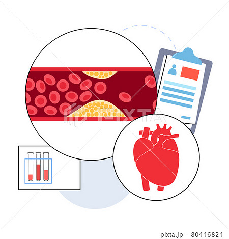 Cholesterol heart disease Cholesterol heart disease 80446824