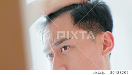 man worried for hair loss man worried for hair loss 80488205