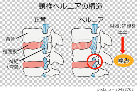 Illustration of cervical disc herniated structure 80488708