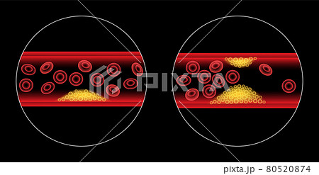 Cholesterol and atherosclerosis 80520874