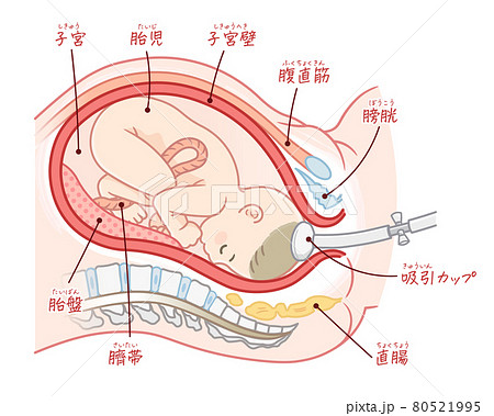 吸引分娩の胎児のイラスト（テキスト付き） 80521995