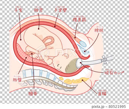 吸引分娩の胎児のイラスト（テキスト付き） 80521995