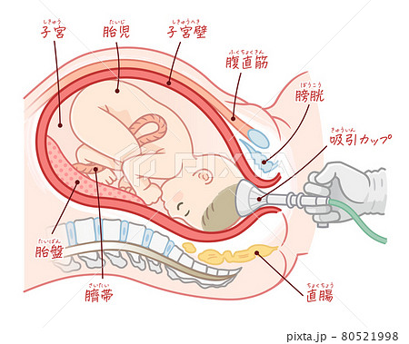 吸引分娩の胎児のイラスト（テキスト付き） 80521998