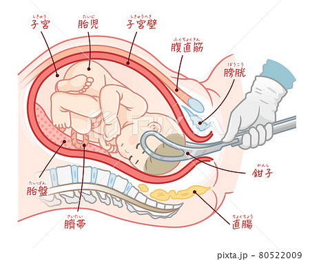 鉗子分娩の胎児のイラスト（テキスト付き） 80522009