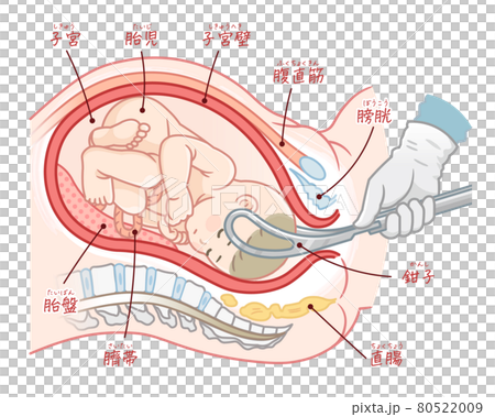 胎鉗分娩的插圖（帶文字） 80522009