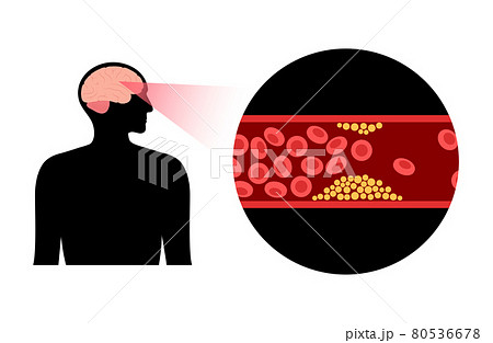Brain stroke ishemic 80536678