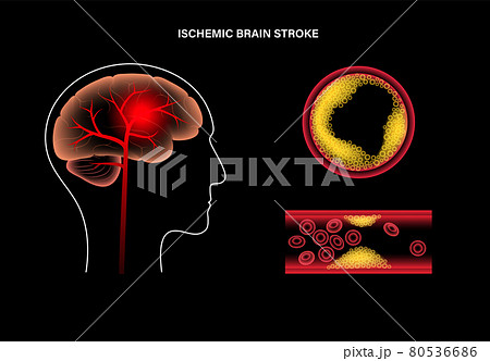 Brain stroke ishemic 80536686