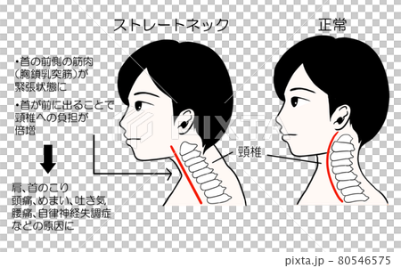 ストレートネック スマホを見る姿勢による病気のイラストのイラスト素材 ストレートネック スマホを見る姿勢による病気のイラストのイラスト素材