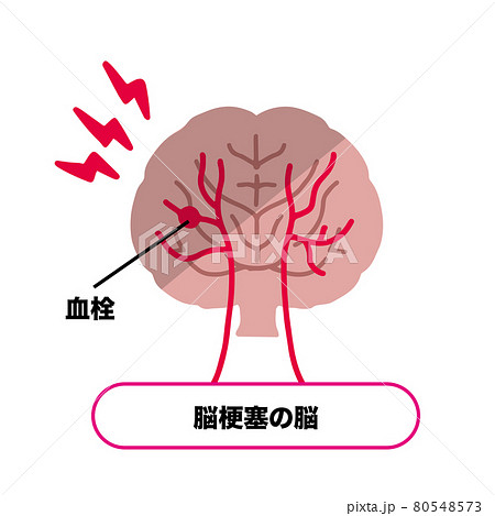 脳梗塞の仕組み