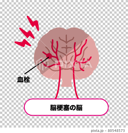 脳梗塞　血栓ができた脳のイラスト 80548573